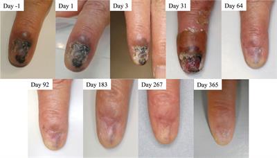 Acral cutaneous malignant melanoma treated with linear accelerator-based boron neutron capture therapy system: a case report of first patient